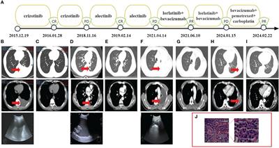 Case report: Precise NGS and combined bevacizumab promote durable response in ALK-positive lung adenocarcinoma with multiple-line ALK-TKI resistance